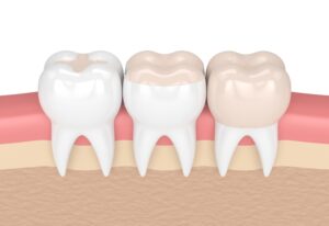 Dental Inlays and Onlays Services in Millersville, MD