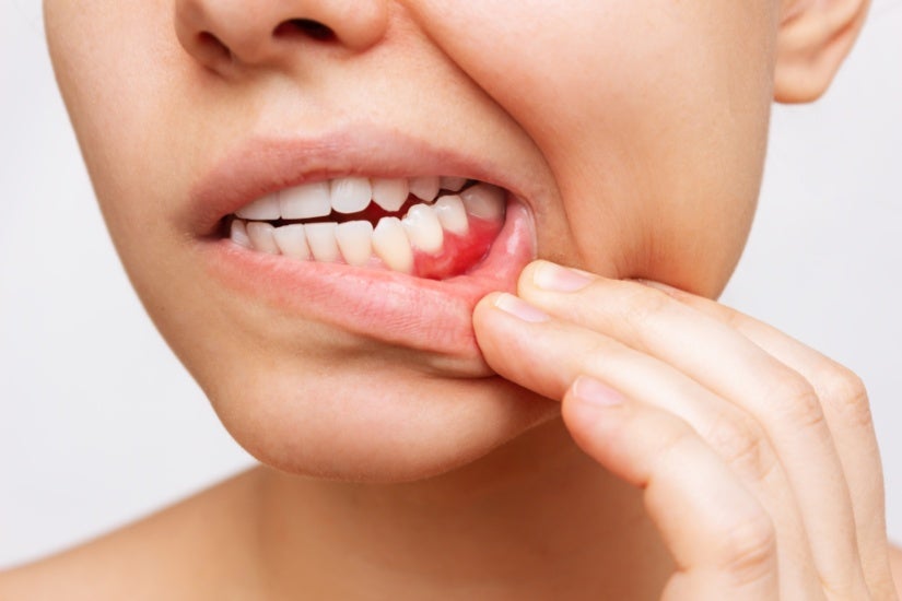 Abscessed Tooth with Inflamed Gums being treated in Millersville, MD