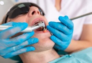 Dental sealants being applied to a molar tooth in Millersville, MD