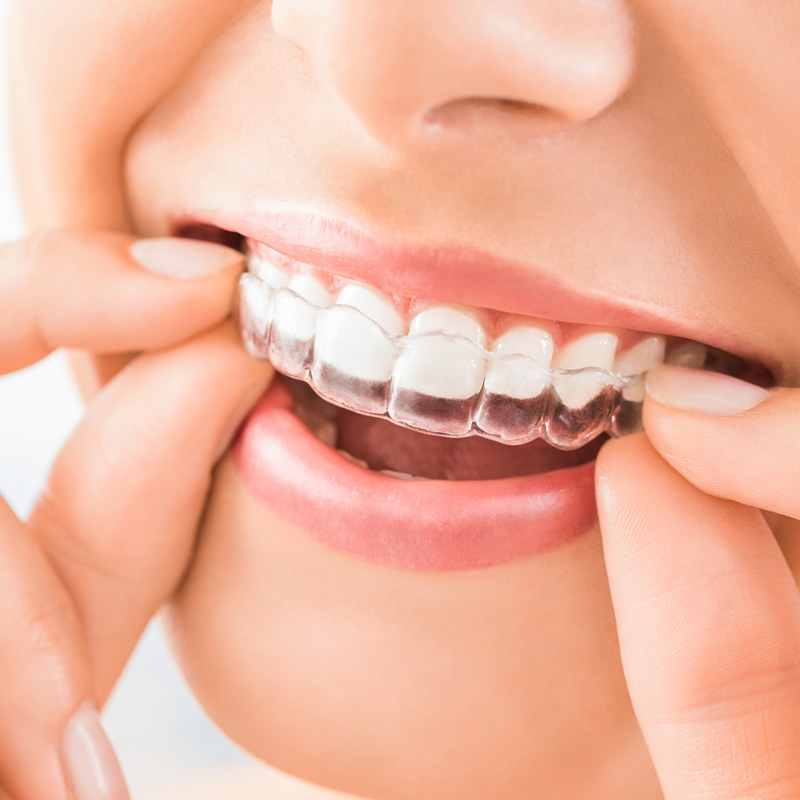 someone smiling with invisalign