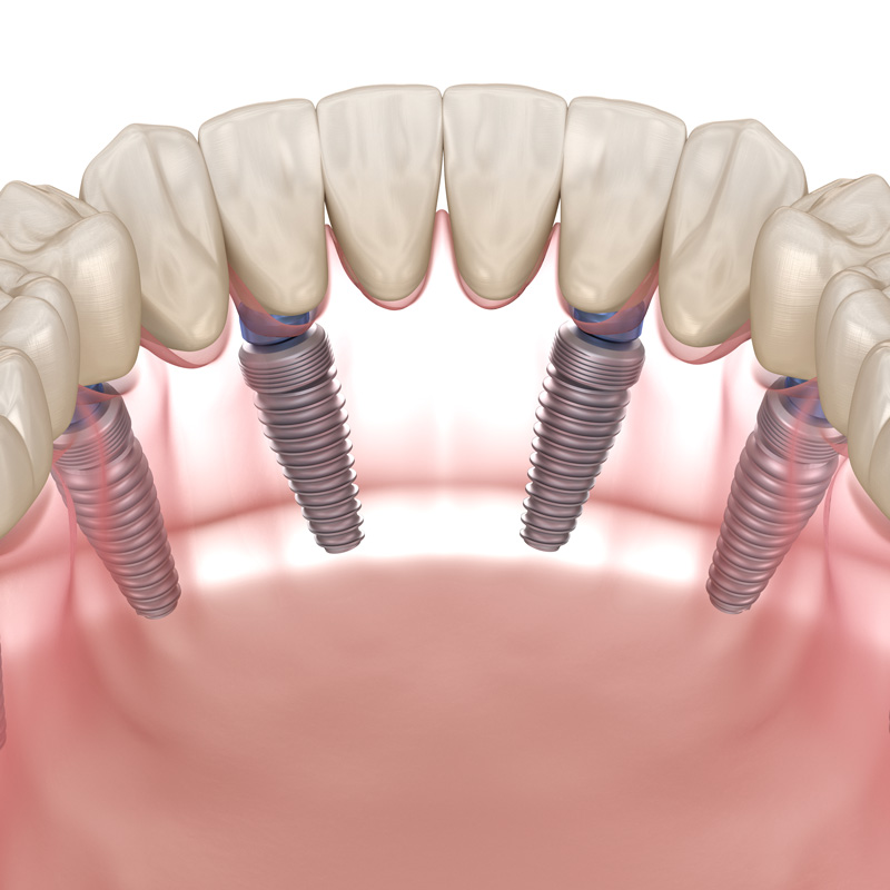 3D model of dental implants