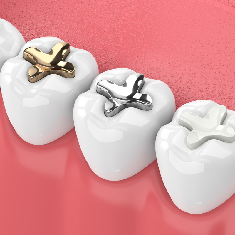 dental onlays and inlays
