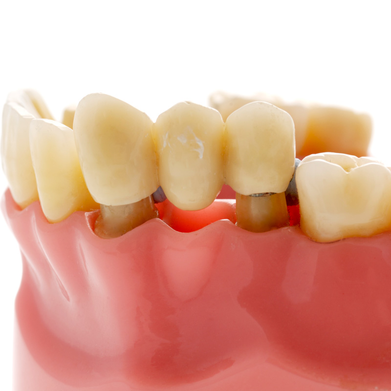 dental bridge