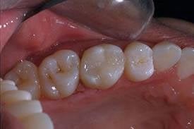 Tooth color fillings